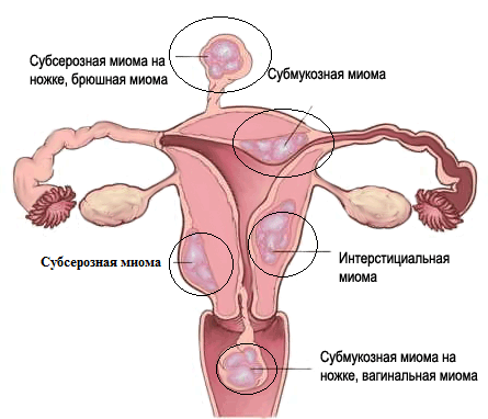Схема миомы матки
