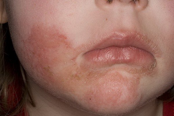Атопический дерматит на лице у ребёнка