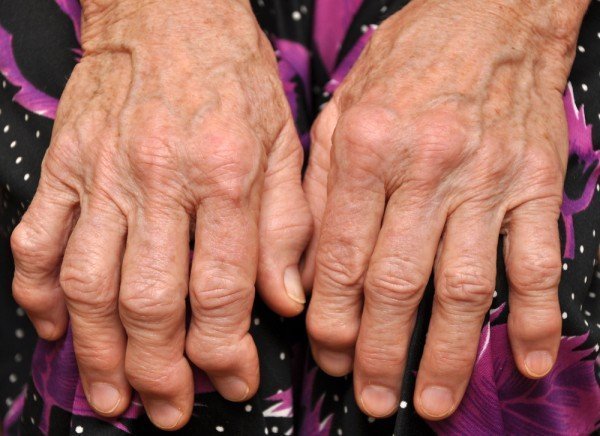 Как лечить полиартрит пальцев рук народными средствами